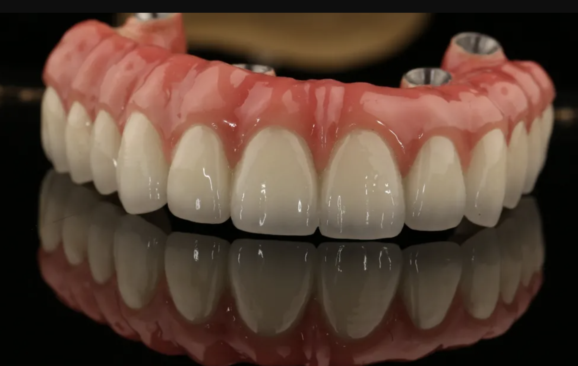 Dental Implants